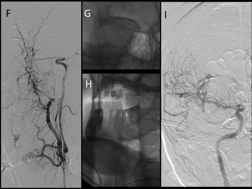 Fig. 14: La arteriografía cerebral confirma los hallazgos tomográficos (F), por lo que se procede a realizar trombectomía mecánica con