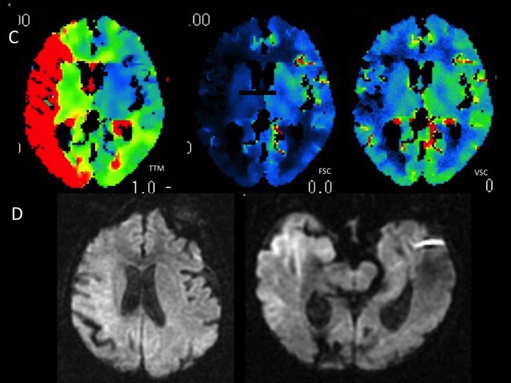 Fig. 26: Los mapas de perfusión cerebral sugieren una lesión isquemica en todo el territorio superficial de la ACM derecha con un infarto establecido (VSC disminuido) a nivel de la corteza insular y