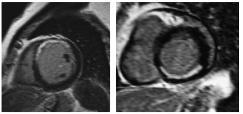 Resonancia magnética cardiaca Función global y segmentaria y engrosamiento. CRM de estrés con dobutamina similar a la ETT.