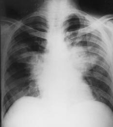 HISTOPLASMOSIS Infección pulmonar aguda Rx: lesiones