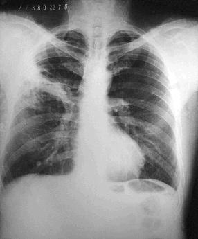 HISTOPLASMOSIS Histoplasmosis pulmonar crónica Rx: : se observan