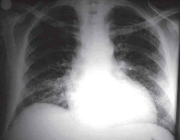 HISTOPLASMOSIS Histoplasmosis pulmonar crónica Rx: se observan micromódulos dispersos en el