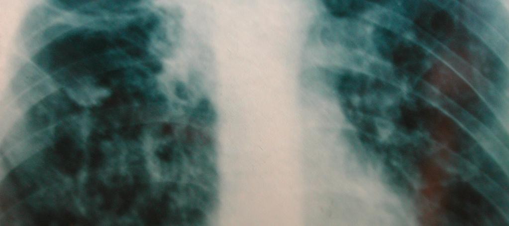 crónica RX: a nivel pulmonar