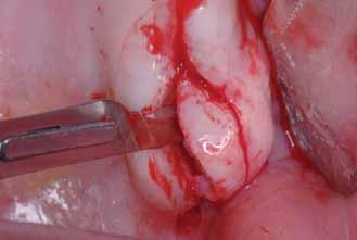 grosor de la mucosa queratinizada por vestibular de los implantes.