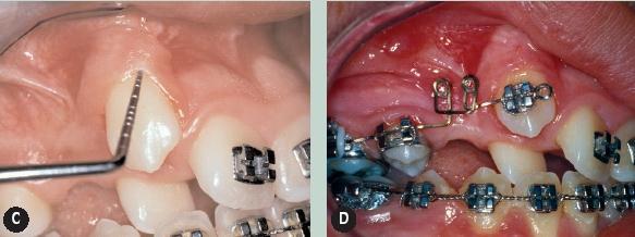 (Macías-Escalada, 2005) La alveoloctomía conductora es la famosa técnica de tunelización, en dónde se expone la corona del diente retenido, se