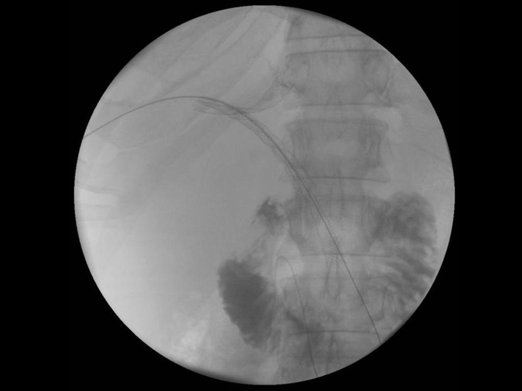Fig. 10: Colocación de stent en Y. Referencias: J.