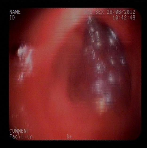 Gastroscopia (28/6/12): Píloro deformado con una neoformación circunferencial, ulcerada, estenosante pero que permite el paso del endoscopio a su través y alcanzar la segunda porción duodenal