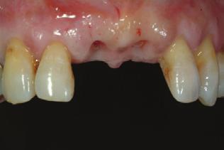 Relaciones ortodoncia-periodoncia. Relaciones endo-periodental.