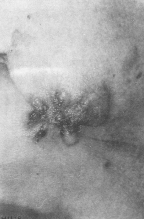LA CIRUGIA DERMATOLOGICA 27 Caso N 7: Paciente de sexo femenino de 66 años de edad con un Carcinoma espinocelular en la región del ángulo mandibular inferior izquierdo (FOTO N 16), luego de extirpada