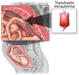 Transfusión Fetal Mejor sitio: vena umbilical a nivel de inserción placentaria. Transfusión Intraperitoneal Riesgo de bradicardia Fetal 3% Vena umbilical 21% Arteria umbilical 2,3% V.