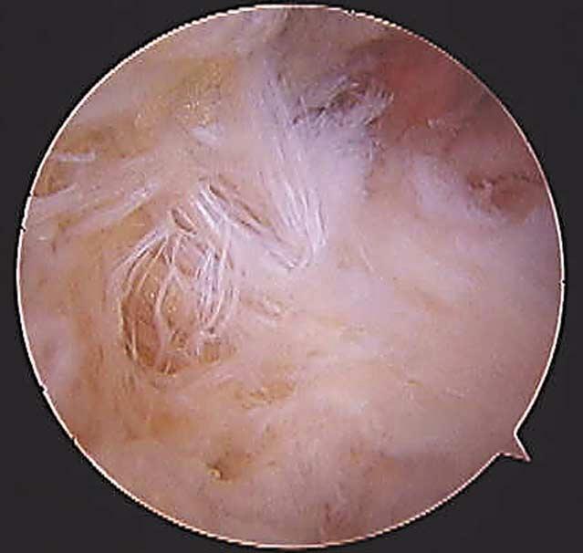 Figura 2: Vista artroscópica del ligamento fibulotalocalcáneo. mos con fibras profundas de la fascia crural, que Rouviére y Canela llamaron ligamento fibulotalocalcáneo (Fig. 2).