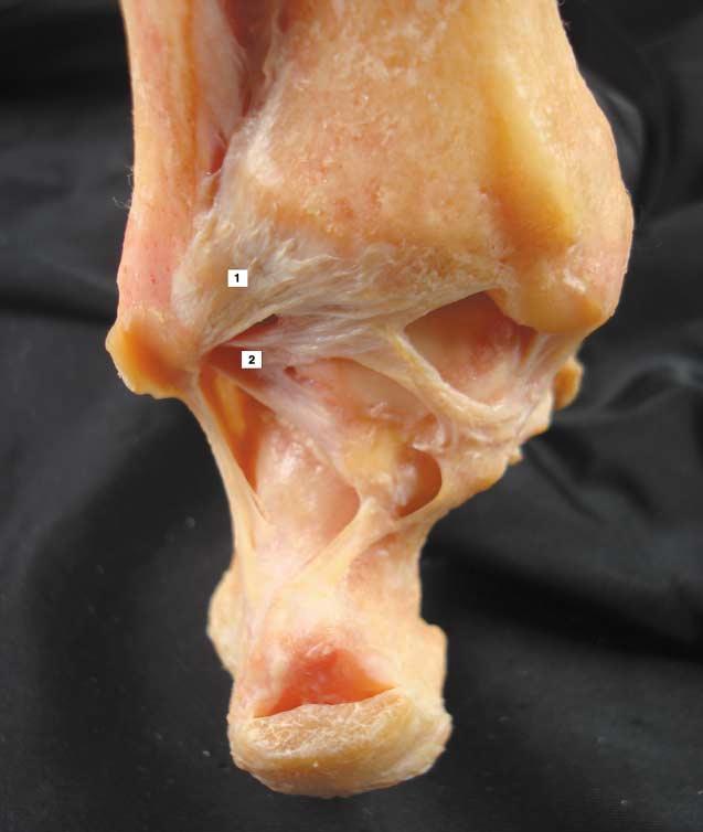 Podemos dividir los ligamentos alrededor de tobillo en tres grupos: ligamentos laterales (talofibular posterior), ligamentos mediales y ligamentos de la sindesmosis tibiofibular (tibiofibular