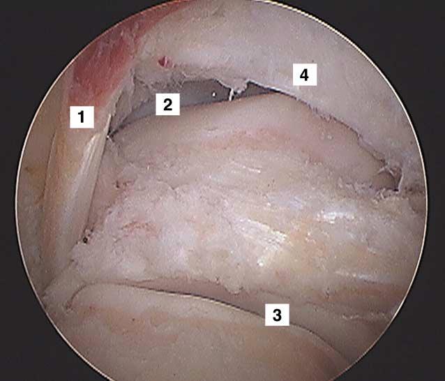Ligamento tibiofibular posterior La mayoría de los investigadores describe al ligamento tibiofibular posterior o posteroinferior con dos componentes uno superficial y otro profundo.
