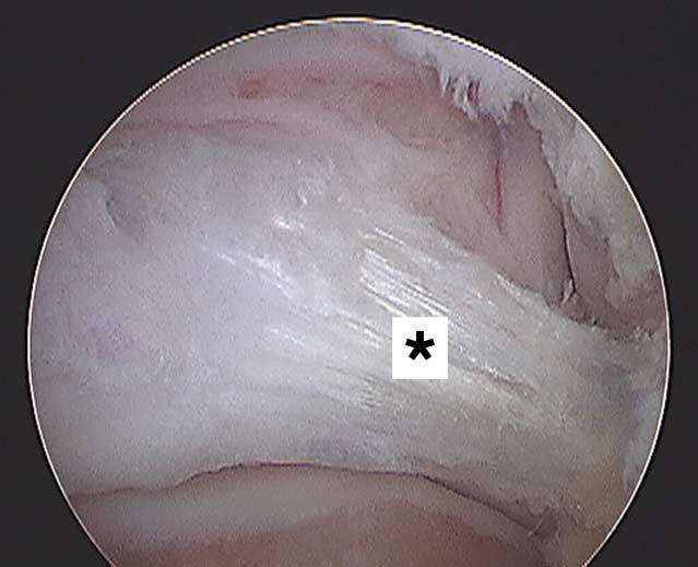 El ligamento talofibular posterior es un ligamento fuerte y grueso con forma trapezoidal localizado en un plano casi horizontal, tener en
