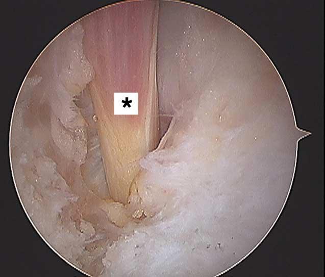Al igual que el portal posterolateral sólo se incide piel y con una pinza roma se toca en forma perpendicular la camisa del artroscopía, ya en el portal posterolateral.