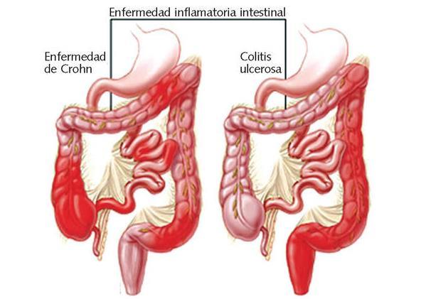 INTRODUCCIÓN Figura 1. Distribución más común de las lesiones en la enfermedad de Crohn y la colitis ulcerosa. Imagen tomada de www.taringa.net 1.2.
