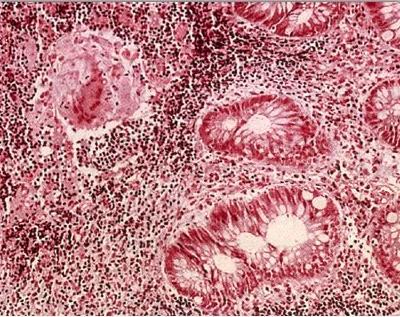 INTRODUCCIÓN Figura 3. Corte histológico de mucosa de intestino grueso con signos de afectación por enfermedad de Crohn.
