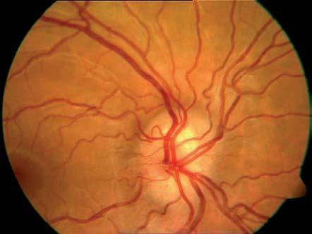 DIAGNÓSTICO DIFERENCIAL Se denomina PSEUDOPAPILEDEMA al aspecto que tienen algunos discos ópticos (más elevados) que puede remedar el de un edema de papila.
