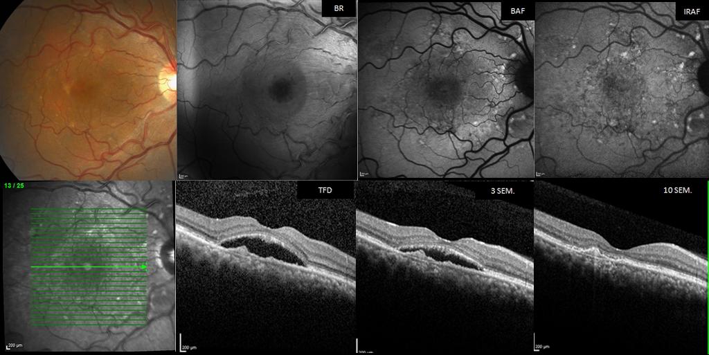 Actualización en el tratamiento de la corioretinopatía serosa central Figura 3. CSC crónica. Nuevo brote en ojo con lesiones crónicas.