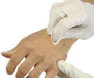 Recomendaciones CDC Publicación- 2011 Durante la inserción Preparación de la piel: Preparar la piel limpia con un antiséptico (alcohol al 70%, tintura de yodo o Gluconato de
