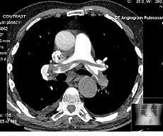 Proceso Tromboembolismo Pulmonar Proceso por el que, tras consultar el paciente (generalmente por disnea y/o dolor torácico) en cualquier punto del Sistema Sanitario Público de Andalucía (SSPA), y