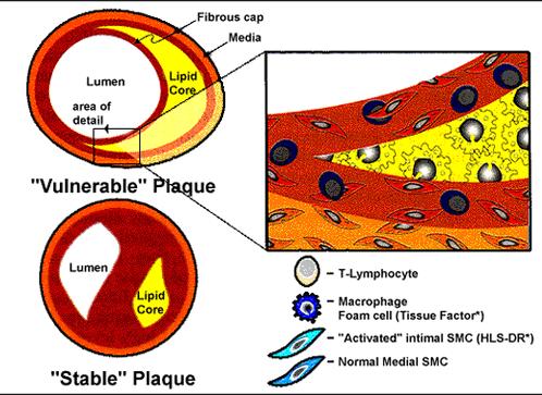 Apoptosis CML y macrófagos Formación de la cápsula fibrosa