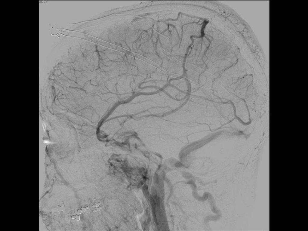 Fig. 6: Angiografía cerebral, fase venosa, proyección lateral: Oclusión de seno sagital superior,