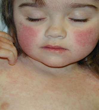 El serotipo B19 gran importancia médica Eritema infeccioso quinta enfermedad Afecta principalmente a niños en los primeros años de la