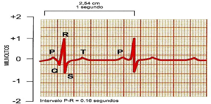 a) Onda P: Primer impulso de la función cardiaca en la aurícula derecha que provoca la contracción de las aurículas; Representa la despolarización