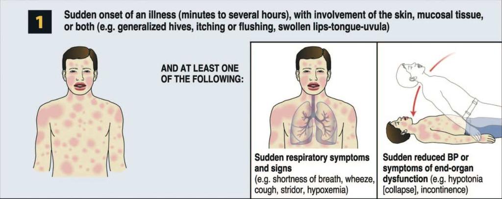Criterios diagnósticos Inicio agudo (minutos a horas) Muco-cutáneo Respiratorio