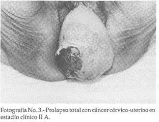 Se realizo una histerectomia vaginal convencional en el caso del IHSS, con cancer IB, porque