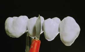 Para una unión óptima entre el material cerámico y la superficie del opacificador, aplicar una pequeña cantidad del material IPS InLine One Dentcisal a la zona cervical e interdental (para los