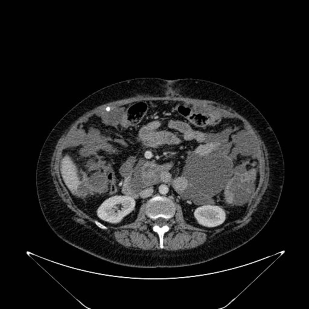 Fig. 13: Control en paciente con Cistoadenocarcinoma mixto de ovario tras extirpación