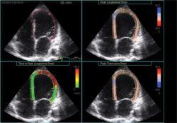 CURSO - 3 ECOCARDIOGRAFÍA SPECKLE TRACKING Objetivo: La ecocardiografía con análisis de la deformación miocárdica se está convirtiendo en una técnica rutinaria para la valoración de diferentes