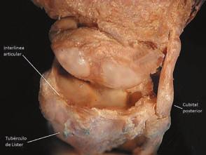 mediocarpiana, la articulación radiocubital; la cabeza del cúbito; el tendón del cubital posterior; la apófisis estiloides del cúbito; el tendón del palmar mayor y el tendón del cubital anterior (Fig.