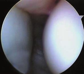 radio. Portal inicial para el palpador, Reparación de ligamento triangular. Portal 6-r Portal inmediatamente radial al tendón del cubital posterior.