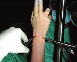 Portal de instrumentación: Palpación de la tensión del ligamento escafolunar desde la articulación mediocarpiana. Reducción de fracturas de escafoides.