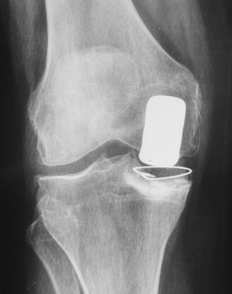 forma retrospectiva las historias clínicas de 15 pacientes a los que se implantaron 16 prótesis unicompartimentales de rodilla (un caso bilateral).
