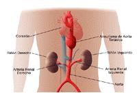 Ilustración 2.2.2 Aneurisma de aorta abdominal Ilustración 2.2.3 Aneurisma de aorta torácica Según su morfología: se clasifican en saculares o fusiformes.