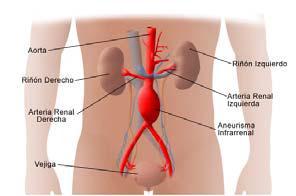 dilatación es simétrica a lo largo de toda la circunferencia de la pared arterial, es decir, la protuberancia o globo se muestra en todos los lados de la arteria