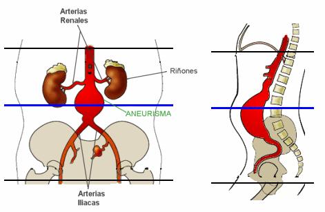 Ilustración 2.3.3 Fases de degeneración de la arteria. 2.4.