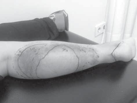 Figura 3. Marcaje de la progresión de las reacciones locales en la pierna de un paciente. Imagen por cortesía de S. Nogué. un mínimo de 6 horas, sin ser necesario el ingreso.