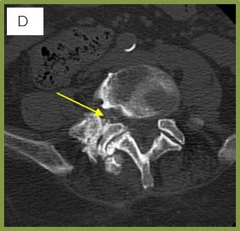 Clinical outcome of microsurgical bilateral decompression via unilateral approach for lumbar canal stenosis: minimum five-year follow-up. Spine.