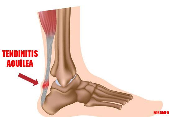 Tendinitis aquílea: síntomas, tratamientos y más La tendinitis aquílea (también conocida como tendinitis del talón de Aquiles) es la lesión de la banda de tejido (tendón) que corre por la parte