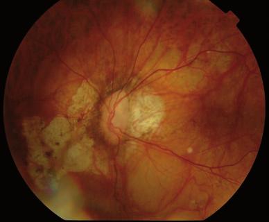 intrarretinianos presentaban tracción de la hialoides, mientras que sólo el 12,1% de los ojos sin presencia de quistes tenían tracción.