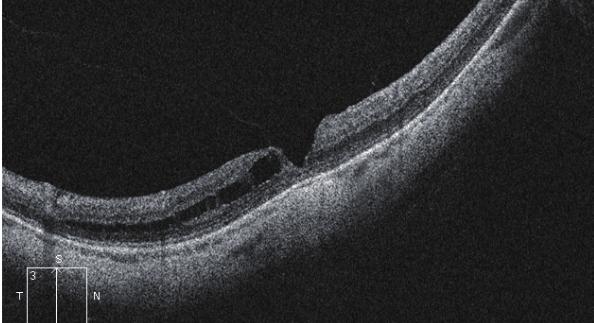 Cuando analizamos los ojos con retinosquisis paravascular, encontramos que el 14,73% presentaban una