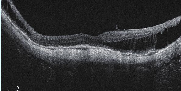 Lesiones paravasculares y retinosquisis macular 121 Figura 64.