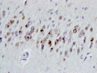 astrocytes), así como ovillos globoides en neuronas y glía a nivel subcortical (Figura 4.6-a).