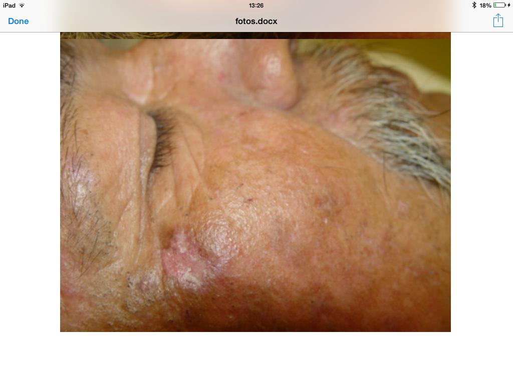 presenta atrofia central, este caso es un lupus eritematosos discoide.