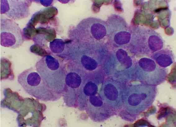 La última clasificación de la Organización Mundial de la Salud (OMS) recoge dos variantes del carcinoma folicular, la variante oncocítica (carcinoma de células de Hürthle) y la variante de células